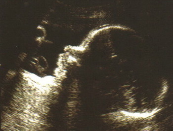 Tauchen in der Schwangerschaft? © Anke Fabian, Archiv Taucher.Net